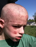 Alex's head - staph infection